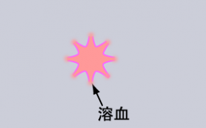 急性溶血性输血反应